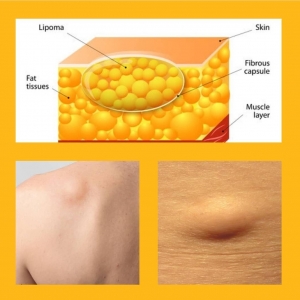 Masszázs előtti bőrdiagnosztika - a LIPÓMA! 1